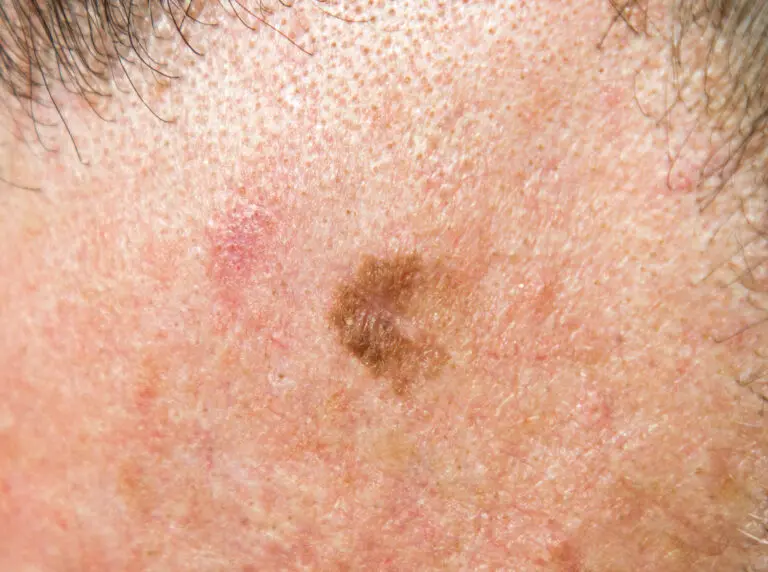 Melanoma