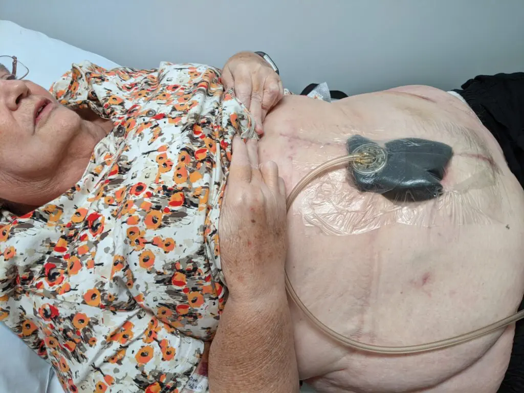 Woman with a medical device on her stomach