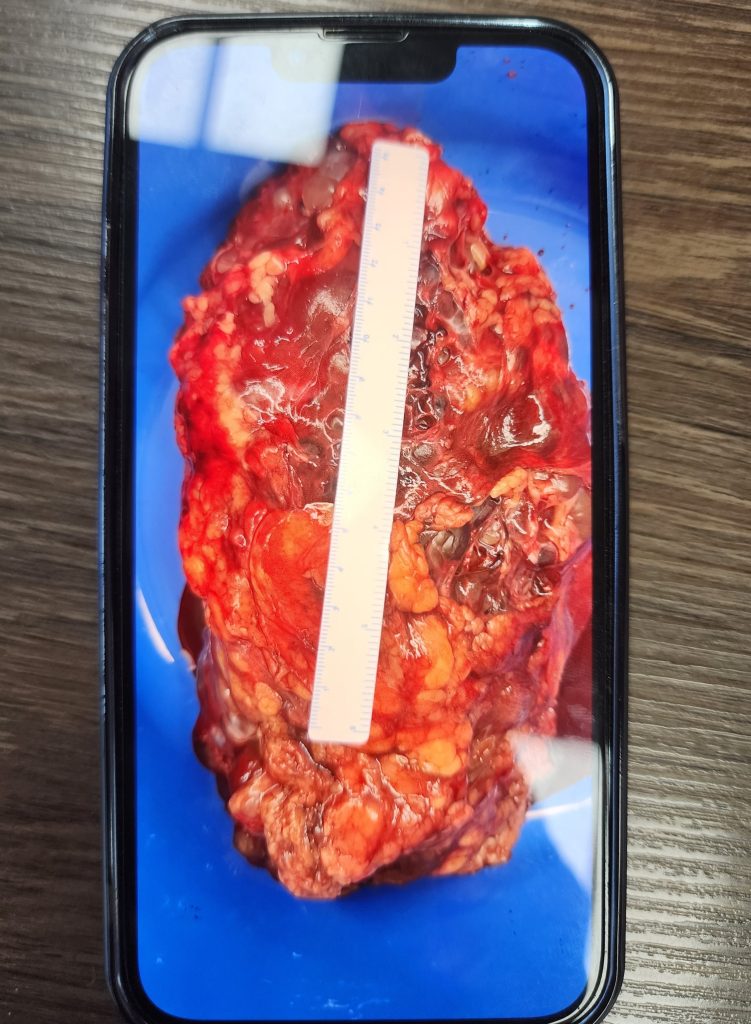 Image of a kidney on phone