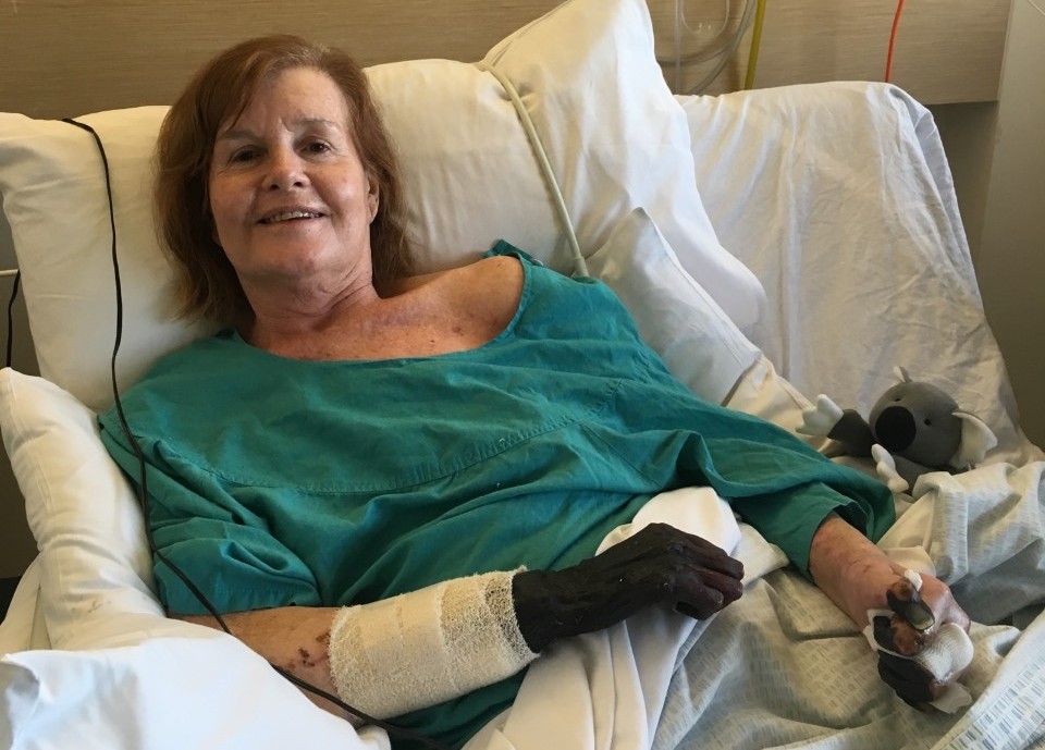 Woman in hospital with gangrene hands