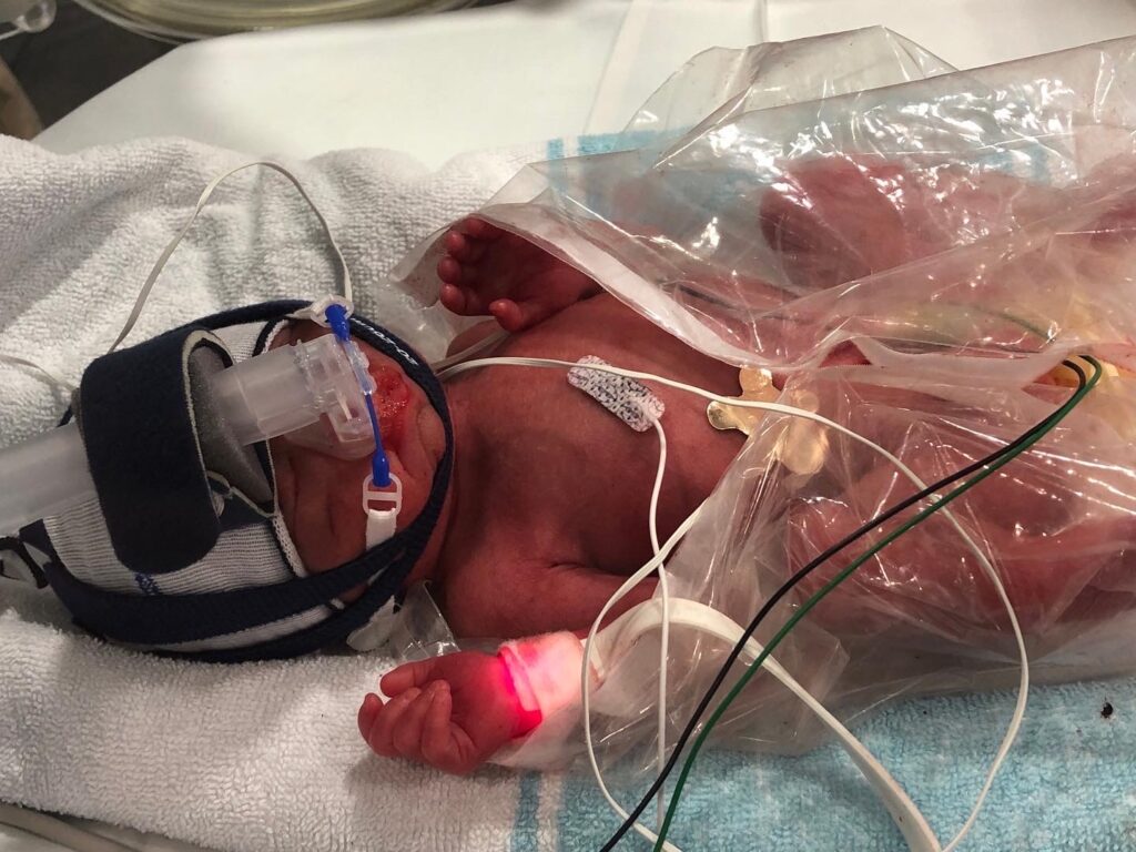 Little Kento is fighting bravely in NICU