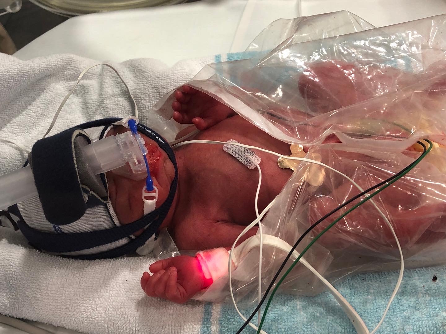 Little Kento is fighting bravely in NICU