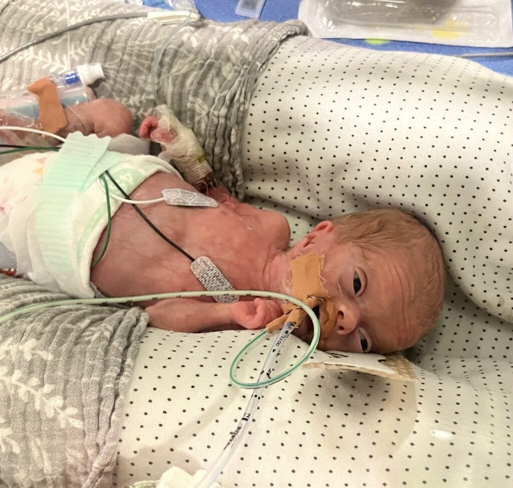 A premature newborn baby