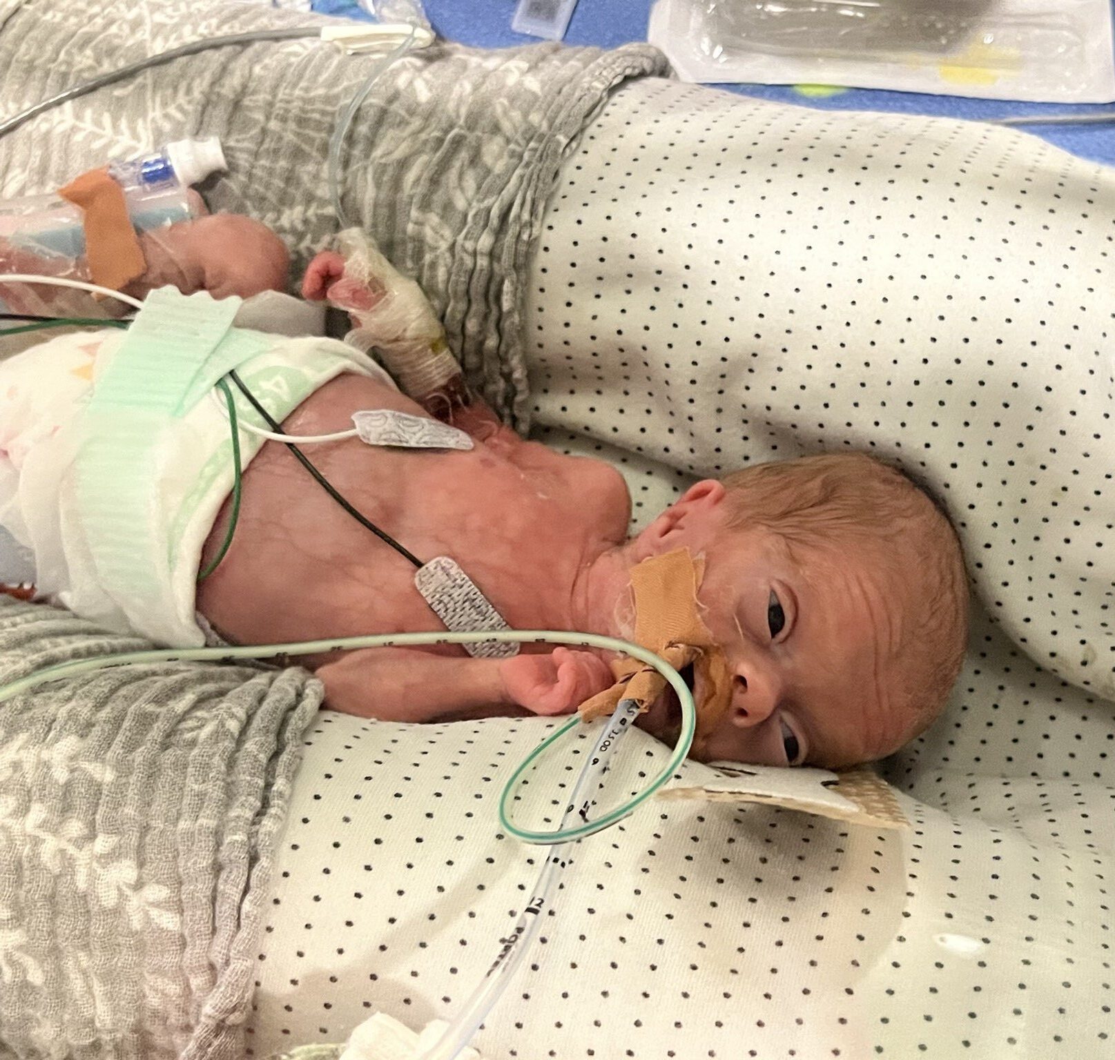 A premature newborn baby